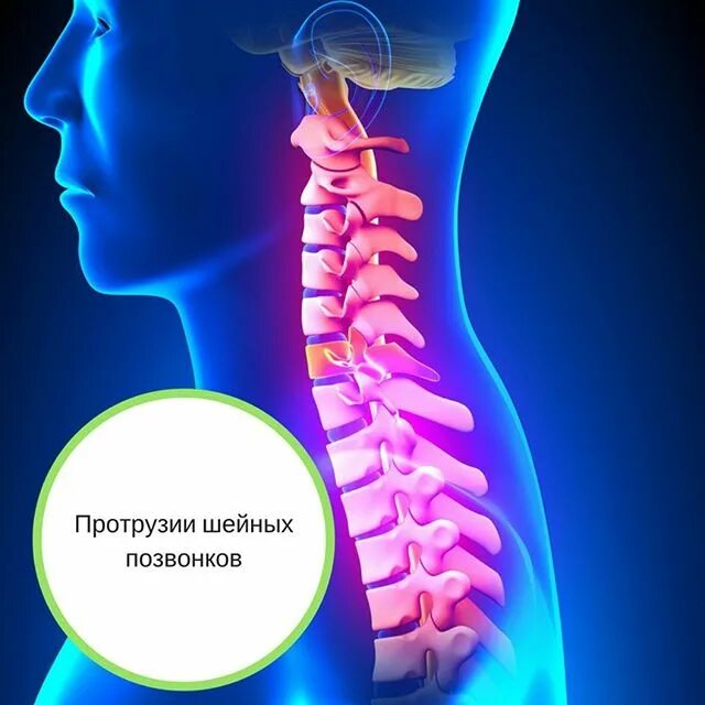 Протрузия шейного отдела позвоночника симптомы. Эртрузия шейного отдела. Протрузии шейного отдела позвоночника. Протрузия шейного отдела позвоночника. Протрузия дисков позвоночника шейного отдела.