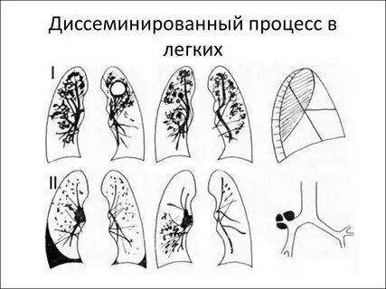Острый очаговый туберкулез