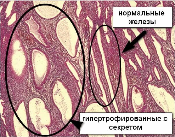 Железистая гиперплазия предстательной железы. Железистая гипертрофия предстательной железы микропрепарат. Гипертрофия предстательной железы микропрепарат. Гиперплазия предстательной железы микропрепарат. Микропрепарата железистая гиперплазия эндометрия.