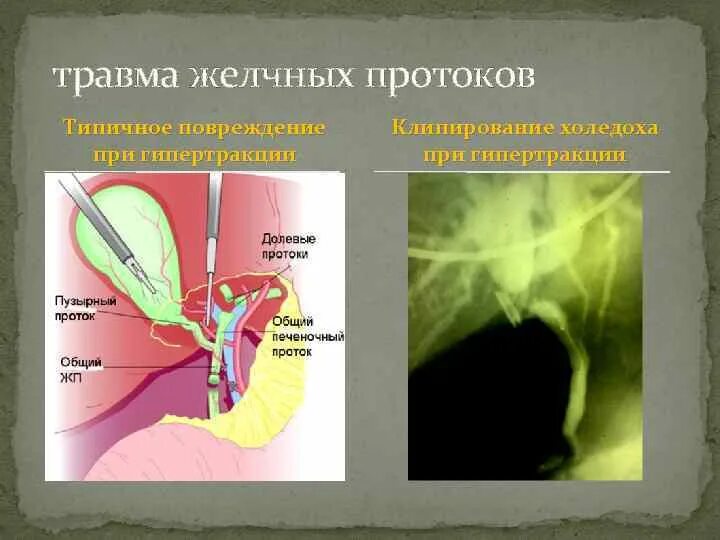 Болезнь желчных протоков. Повреждение внепеченочных желчных протоков. Ятрогенное повреждение холедоха. Типы травматического повреждения холедоха. Повреждение общего желчного протока.