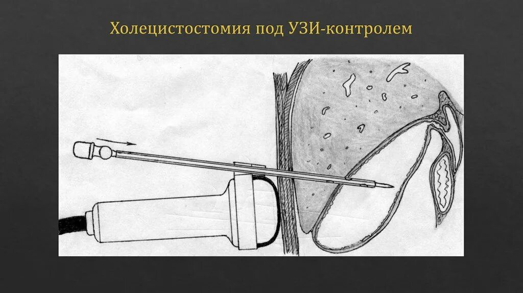 Дренирование желчного пузыря. Дренирование желчных протоков под контролем узи. пункция желчного пузыря под контролем узи. дренирование желчного пузыря под контролем ультразвукового. пункция поджелудочной железы.