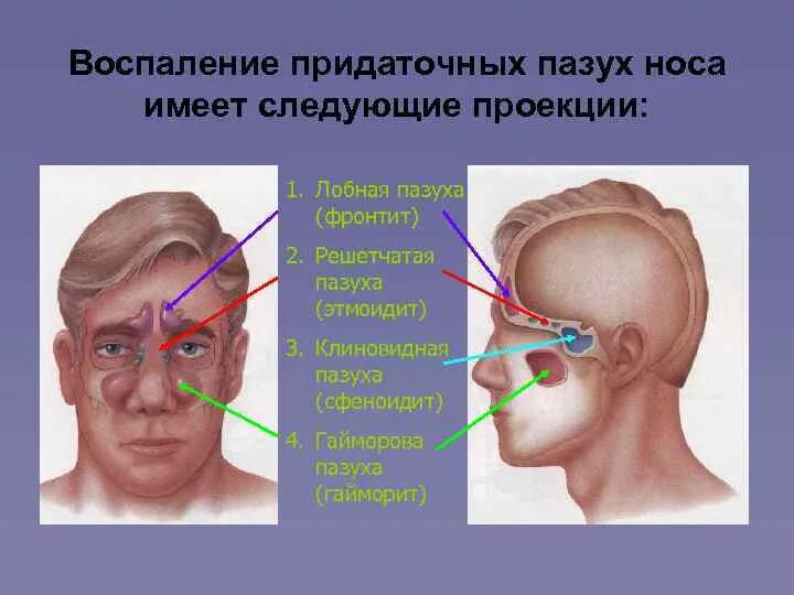 Воспаление придаточных пазух носа