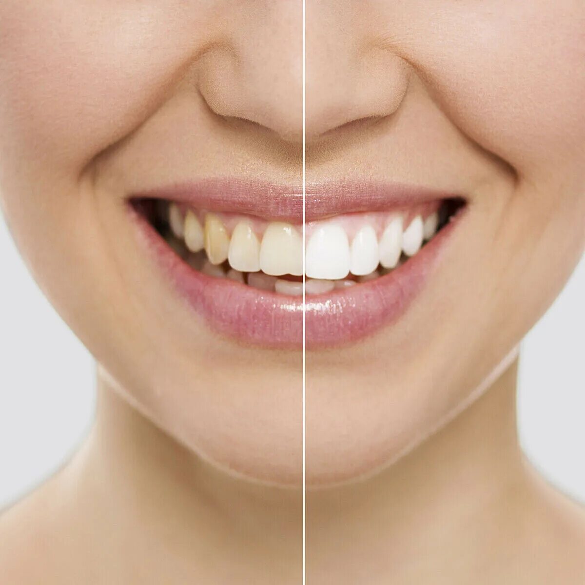 Идеальные зубы. Белоснежные зубы. Красивая улыбка зубы. Красивые белые зубы.