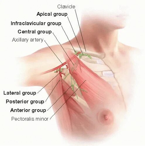 Лимфоузлы под мышками расположение у женщин. Подключичные лимфоузлы. Схема лимфатических узлов под мышкой. Лимфоузлы подмышечной области опухоль. Воспаленные лимфоузлы на ключице.