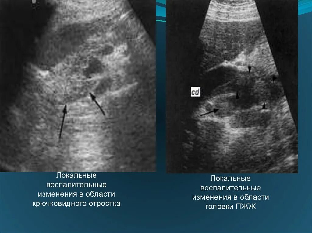 Кальцинат в печени на узи. Острый панкреатит на УЗИ. Крючковидный отросток поджелудочной железы. УЗИ картина поджелудочной железы. Крючковидный отросток поджелудочной железы на УЗИ.