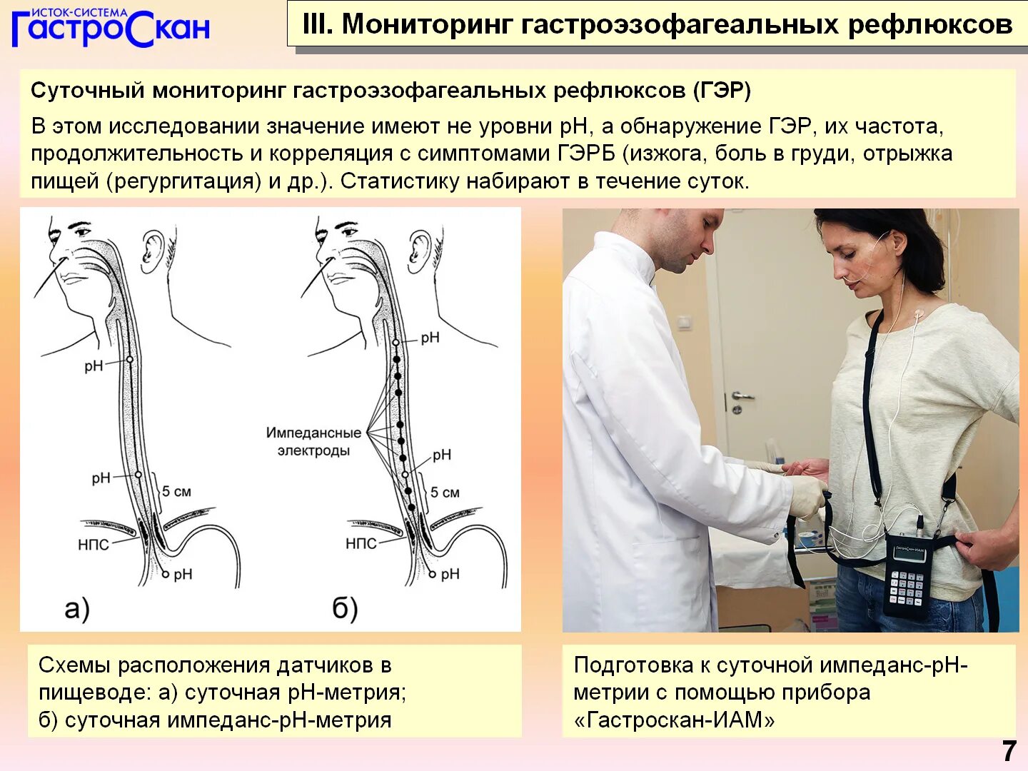 Кашель при рефлюкс эзофагите симптомы и лечение. Гастро-эзофагальной рефлюксной болезни. суточный рефлюкс-мониторинг. импеданс ph метрия. суточная импеданс-ph-метрия пищевода.