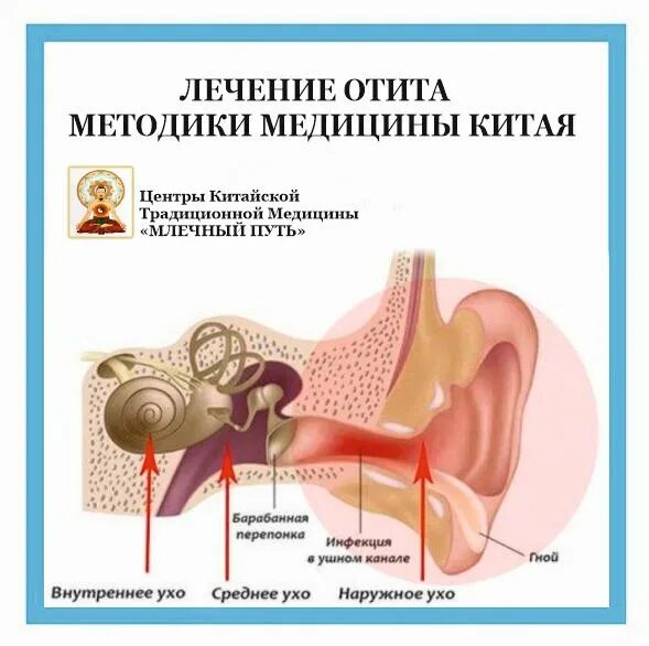 Воспаление среднего уха. Воспаление среднего уха у детей. Воспаление наружного уха. Отит эффективное лечение