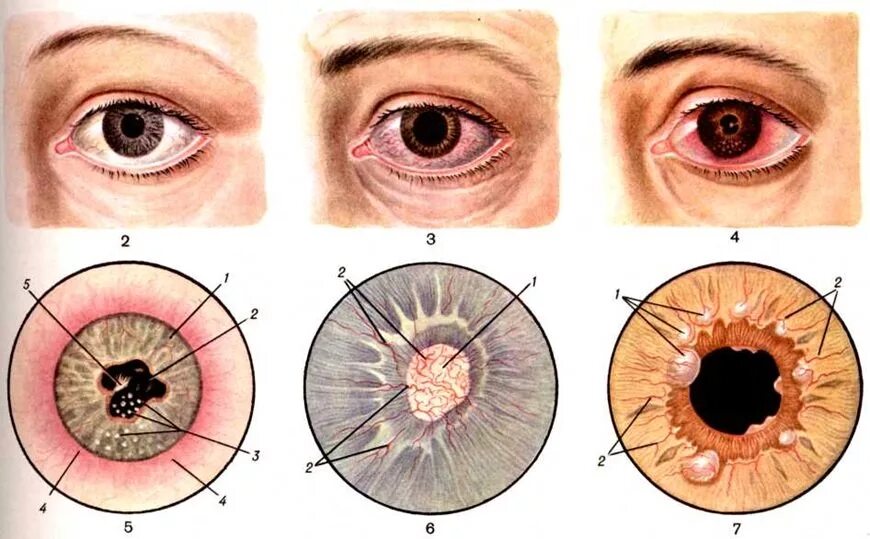 Ирит иридоциклит хориоретинит. Увеит, Ирит, иридоциклит. Конъюнктивит кератит иридоциклит. Болезни радужки