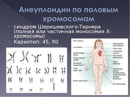 Моносомия кариотип