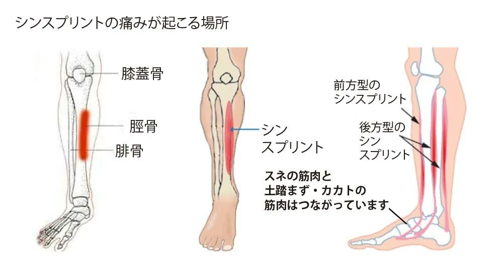 Боль в голени спереди причины. Шинсплинт Расколотая голень. Медиальный большеберцовый синдром. Медиальный большеберцовый стресс-синдром.