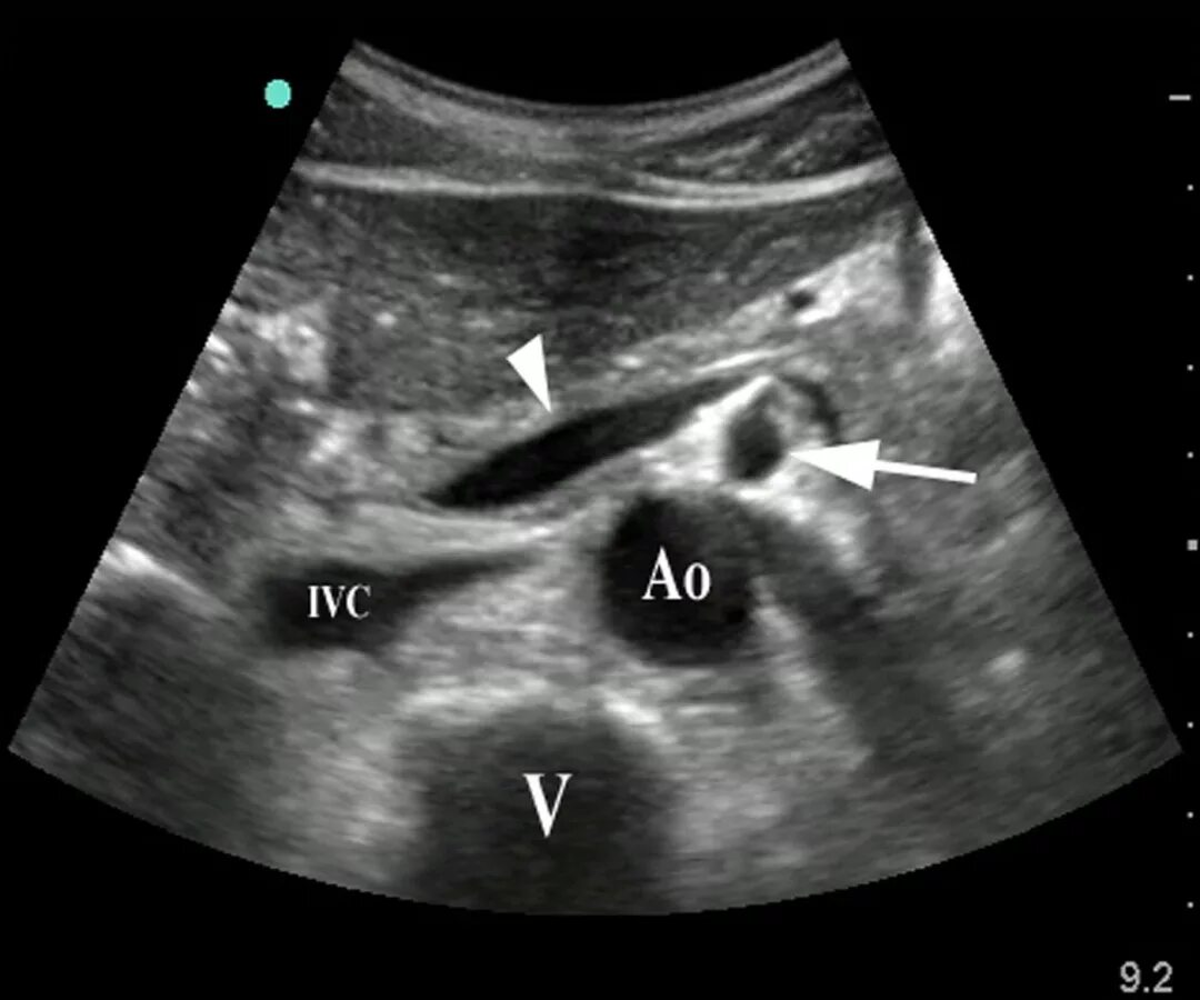 Портальная гипертензия на УЗИ. Расширение воротной вены на УЗИ. Портал ная гипертензия УЗИ. Тромбоз селезеночной вены на УЗИ. Расширение селезеночной вены