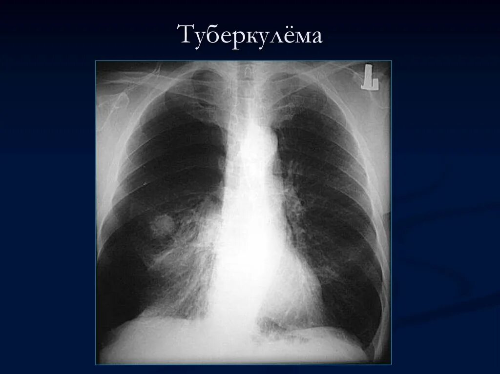 Туберкулез на рентгене легких