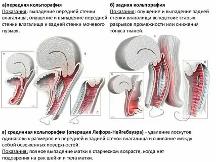 Пролапс задней стенки