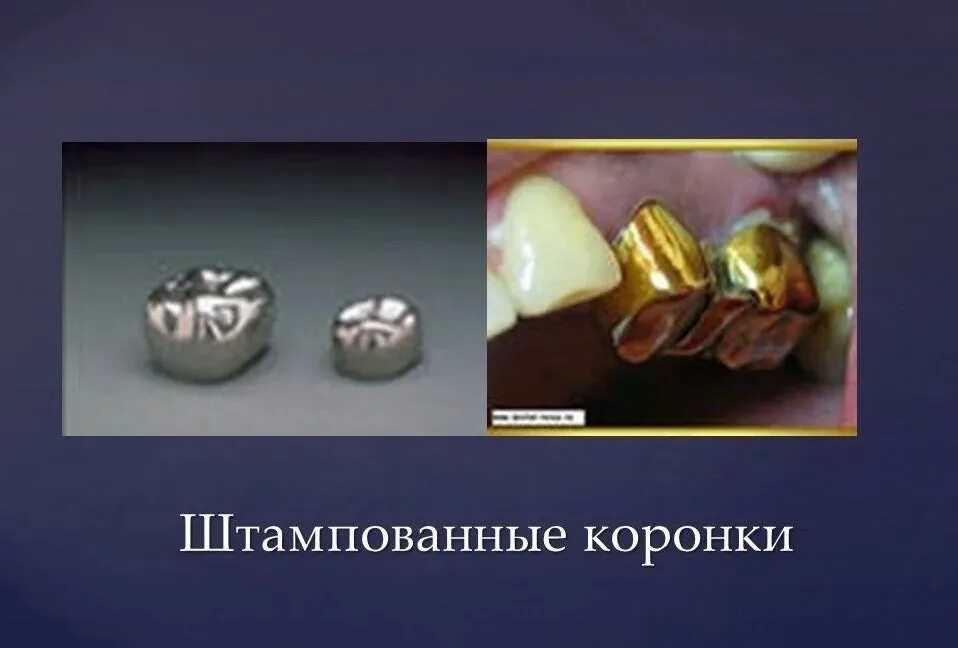 Комбинированных штампованных коронок (по белкину). Комбинированных штампованных коронок (по белкину). Клинико-лабораторные этапы изготовления штампованных коронок. Лабораторный этап штампованной коронки. Штампик штампованной коронки.