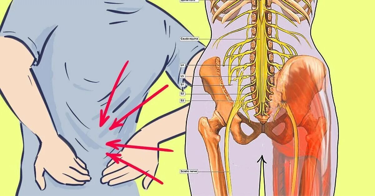 Седалищный нерв позвоночника. Болит спина. Невралгия седалищного нерва. Седалищный нерв схема. Сильно тянет правую