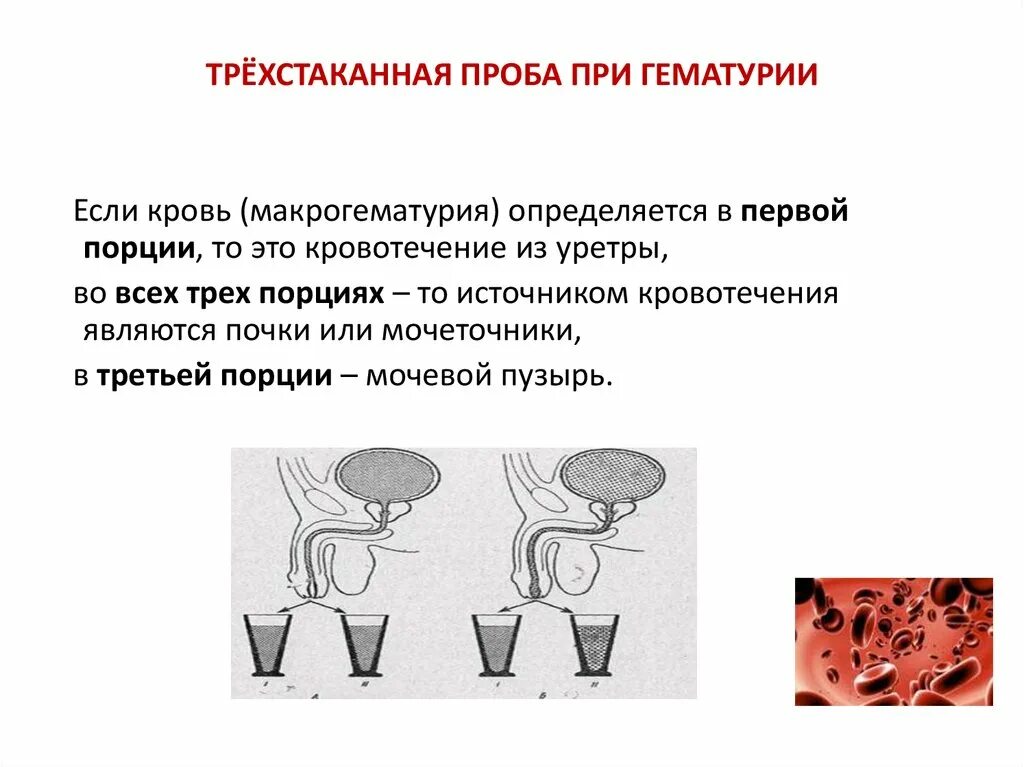 Проба томпсона. Гематурия трехстаканная проба. методика проведения 3-х стаканной пробы мочи. трехстаканная проба при гематурии. трехстаканная проба томпсона.