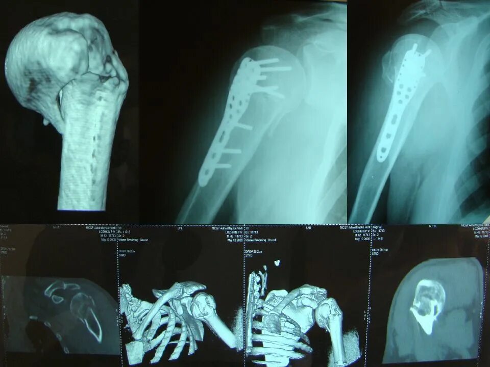 Перелом спустя неделю. Субкапитальный перелом плечевой кости рентген. Надбугорковые переломы плечевой кости. Перелом проксимального отдела плечевой кости. Субкапитальный перелом головки плечевой кости.