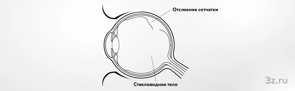 Отслоение сетчатки глаза схема. Сетчатка отслоение схема. Назовите основные методы лечения отслойки сетчатки..