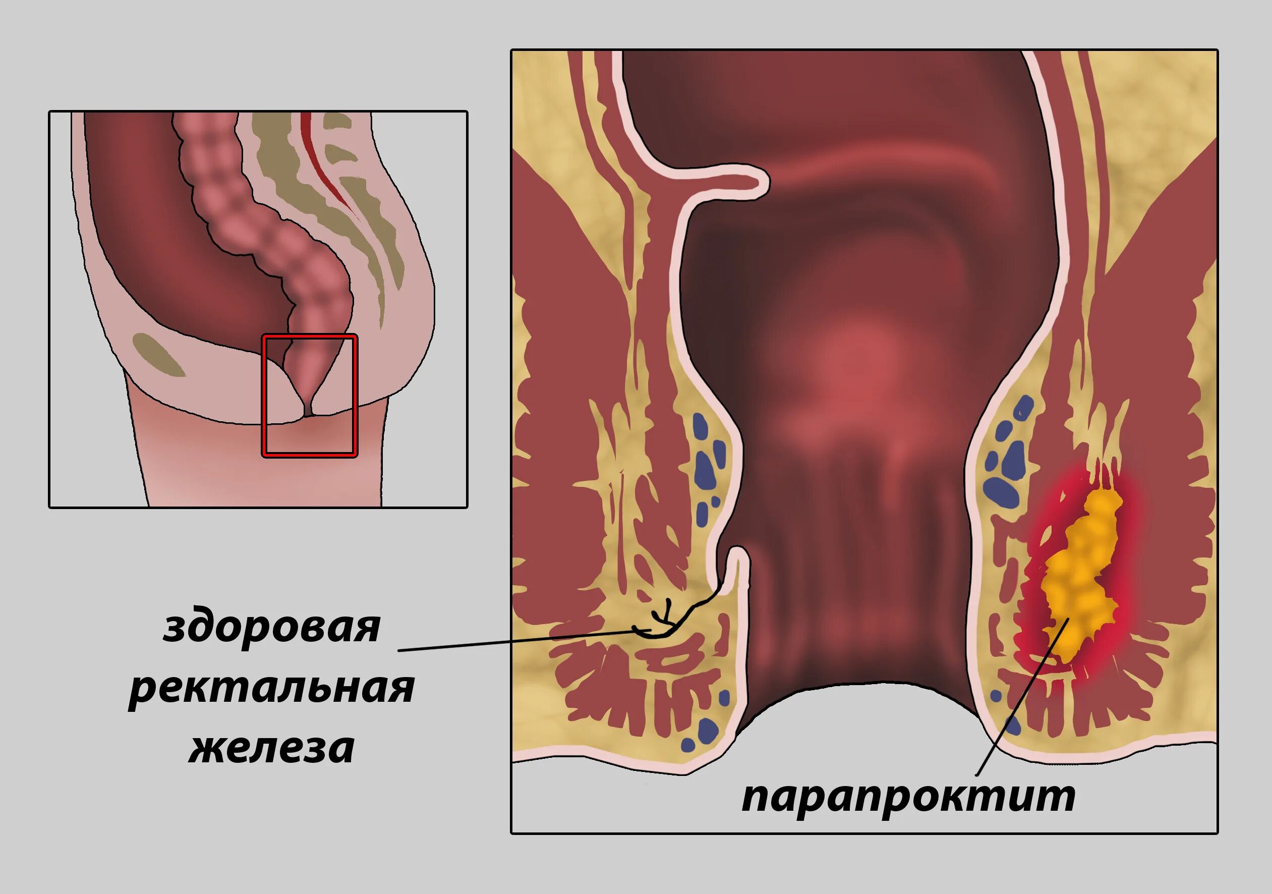 Ощущение в прямой кишке. Парапроктит параректальный свищ. Подкожный парапроктит. Парапроктит и свищ прямой кишки. Гнойный ишиоректальный парапроктит.