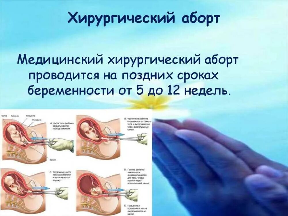 Прерывание беременности сколько. Хирургический аборт на 6 неделе беременности. хирургический аборт на 12 неделе. хирургический аборт сроки. методика проведения аборта.