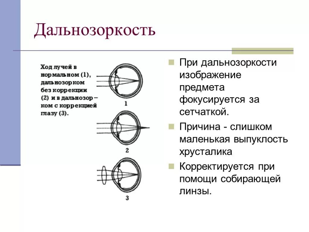 Причины возникновения дальнозоркости. Физика 8 класс причины дальнозоркости. Дефекты зрения дальнозоркость. Дальнозоркость физика сообщение. При гиперметропии изображение фокусируется.