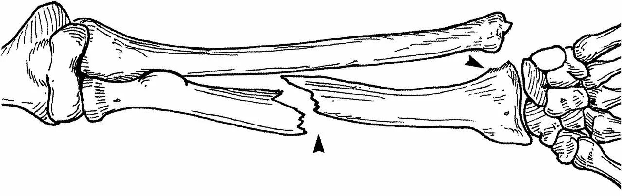 Открытый перелом кости руки. Перелом-вывих Галеацци. Предплечье переломы Галеацци. Перелом Монтеджи и Галеацци. Перелом вывих Монтеджи.