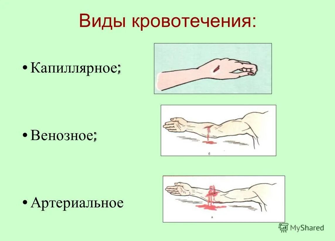 Какое кровотечение наблюдается