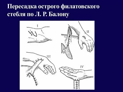 Стебель филатовой