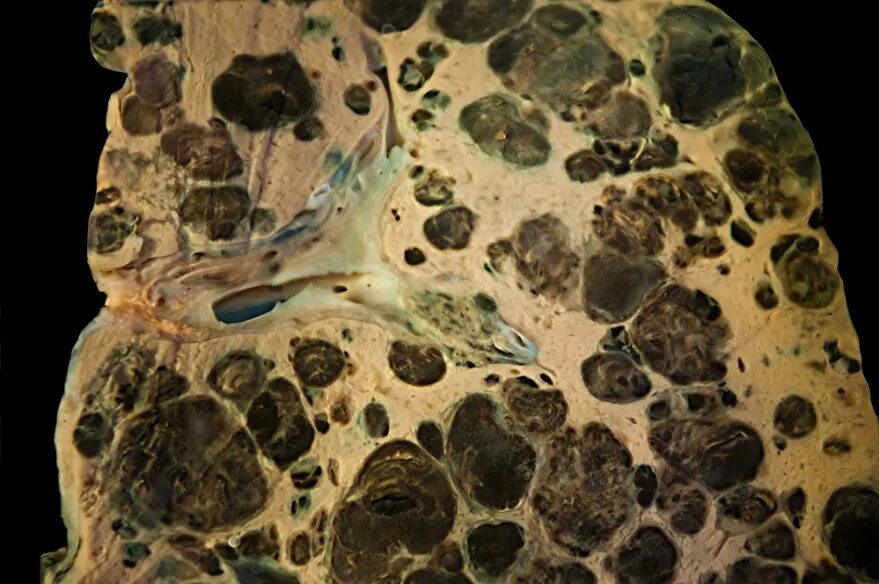 Метастазы в легких рентген. Солитарный метастаз в легком кт. Метастазы меланомы в легкое. Метастазы меланомы в легкое. Пэт-кт множественные метастазы.