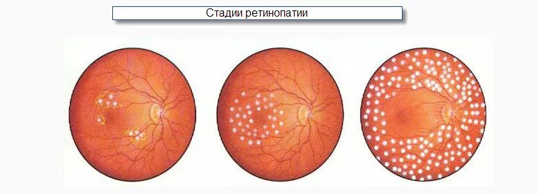 Диабет сетчатка. Пролиферативная диабетическая ретинопатия. диабетическая ретинопатия сетчатки. препролиферативная диабетическая ретинопатия клиника. непролиферативная диабетическая ретинопатия степени.