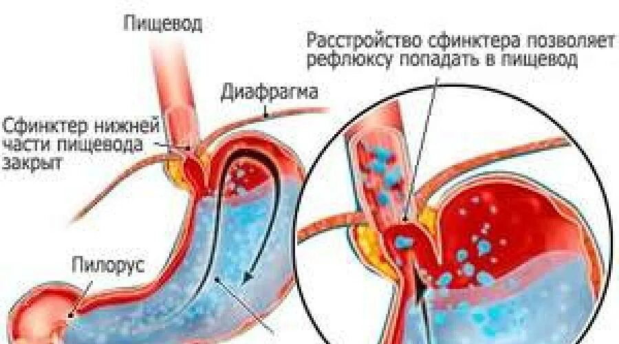 Рефлюкс мочи. Asam Gelugur в медицине.