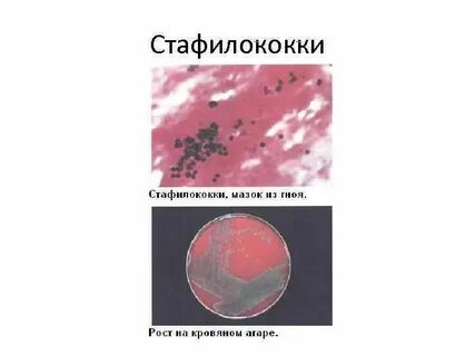 Со стафилококком