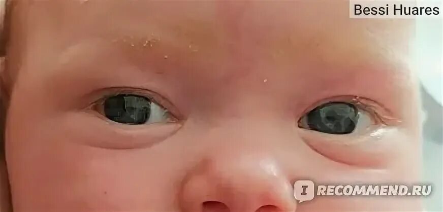 Дакриоцистит как делать массаж. Дакриоцистит как делать массаж