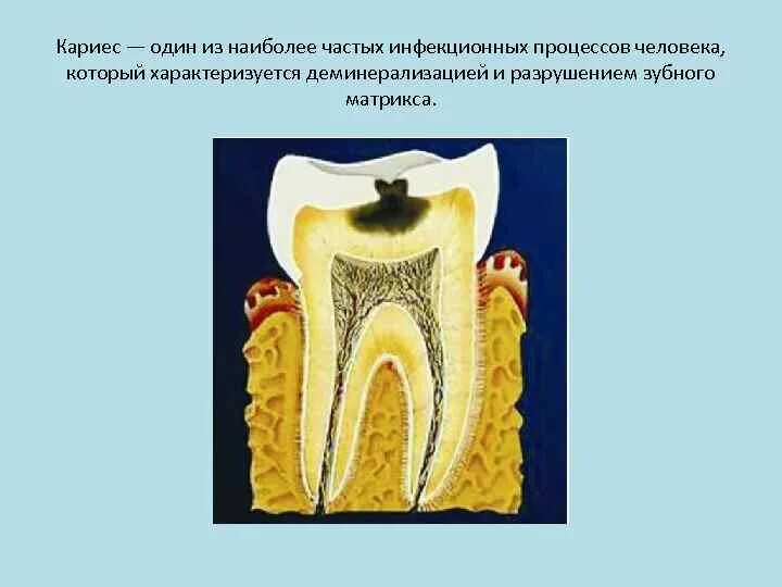 Зубной дентин. Зубной дентин