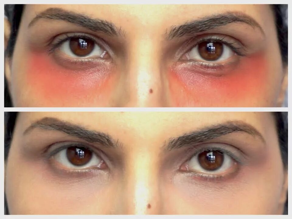 Темные круги под глазами женщин лечение. Коричневые синяки под глазами. Черные круги вокруг глаз. Кровоподтек под глазом. Наследственные синяки под глазами.