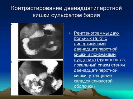 Как проверить 12 перстную кишку