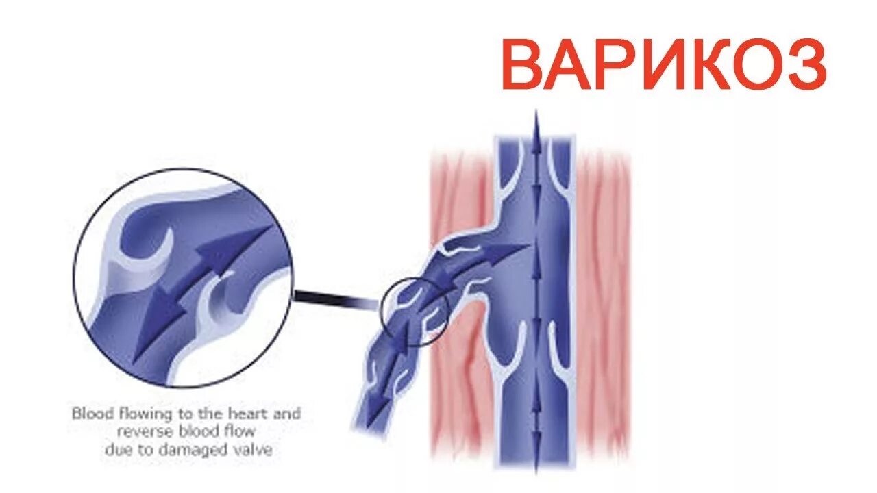 Расширение вен канатика. Варикоз вен семенного канатика. Варикозное расширение вен мошонки. Расширение вен семенного канатика.