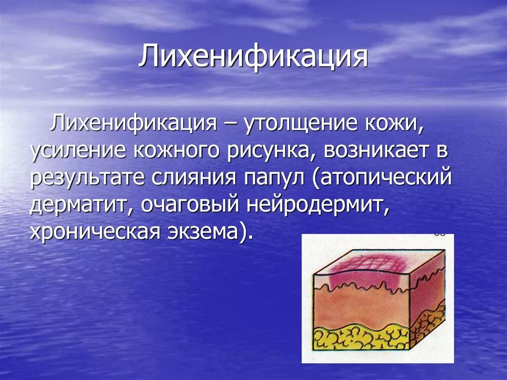 Вторичные морфологические элементы кожи лихенификация. Усиление кожного рисунка. Лихенификация дерматовенерология. Вторичные морфологические элементы кожи ссадина. Усиление кожного рисунка.