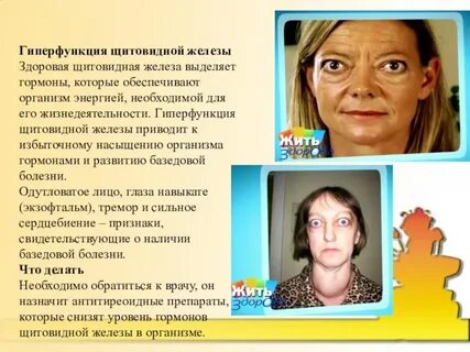 Глаза при щитовидной железе