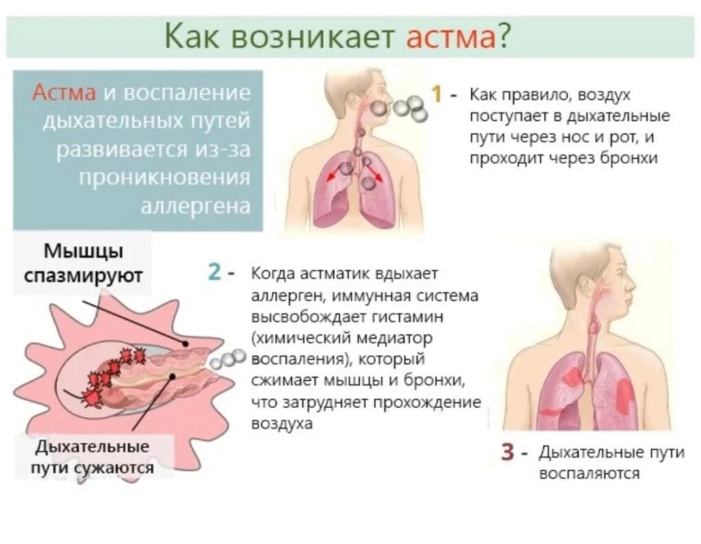 Может ли развиться астма