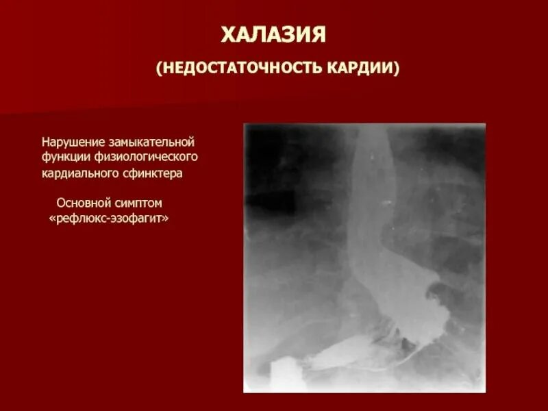 Терапия ахалазии кардии. Терапия ахалазии кардии. Недостаточность функции кардиального жома. Кардия пищевода лечение. Ахалазия пищевода баллонная дилатация.