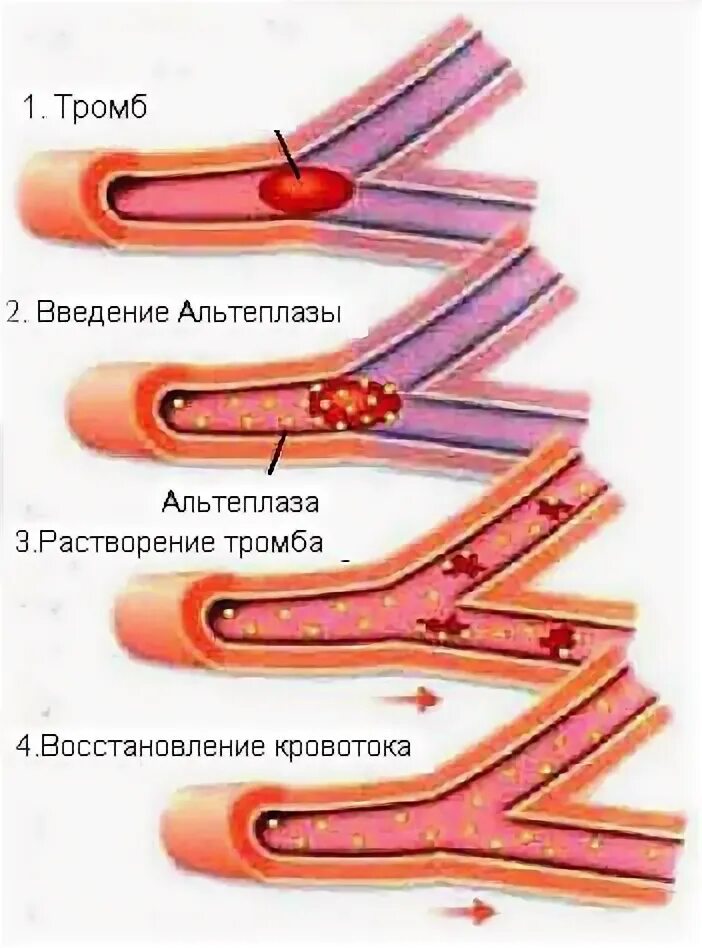 Как растворить тромб. Растворение тромбов в сосудах.