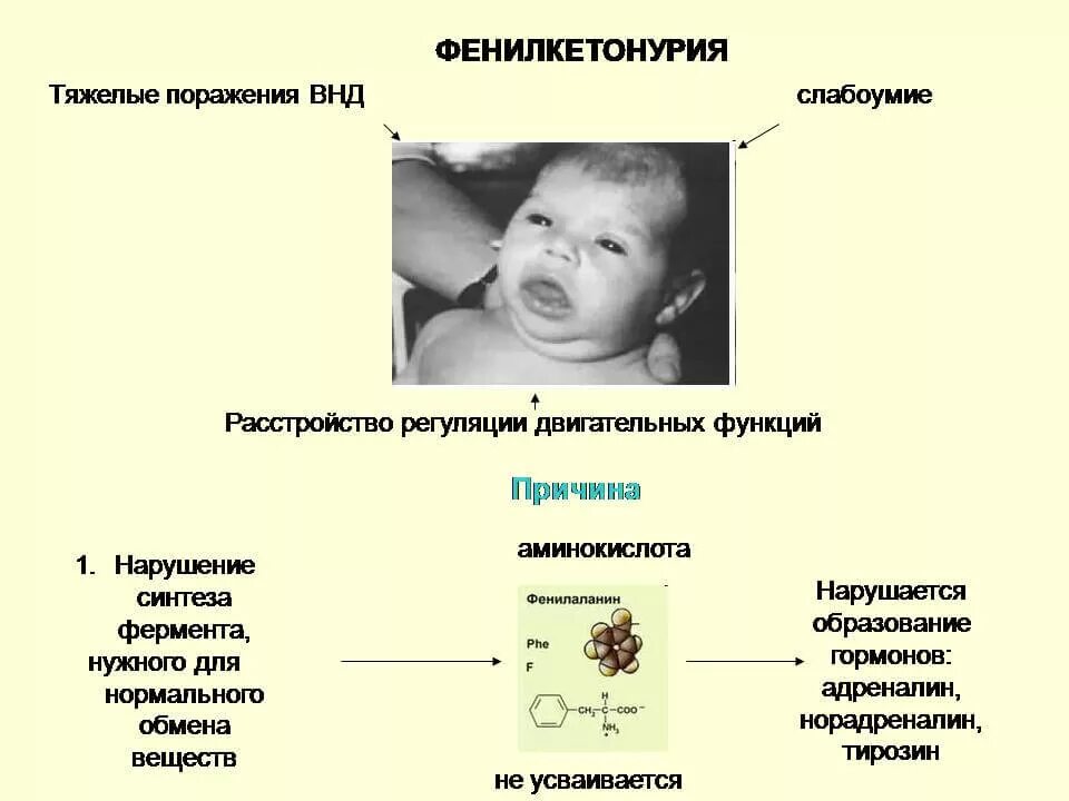 Фенилкетонурия фермент. Фенилкетонурия проявления у детей. Клинические симптомы фенилкетонурии. Фенилкетонурия (фенилпировиноградная олигофрения, синдром Феллинга). Фенилкетонурия симптомы Тип наследования.