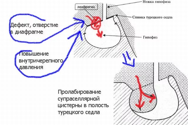 Размер гипофиза. Опухоли гипофиза синдром пустого турецкого седла. Диафрагма турецкого седла мрт. Рентген гипофиза турецкого седла. Мембрана турецкого седла.