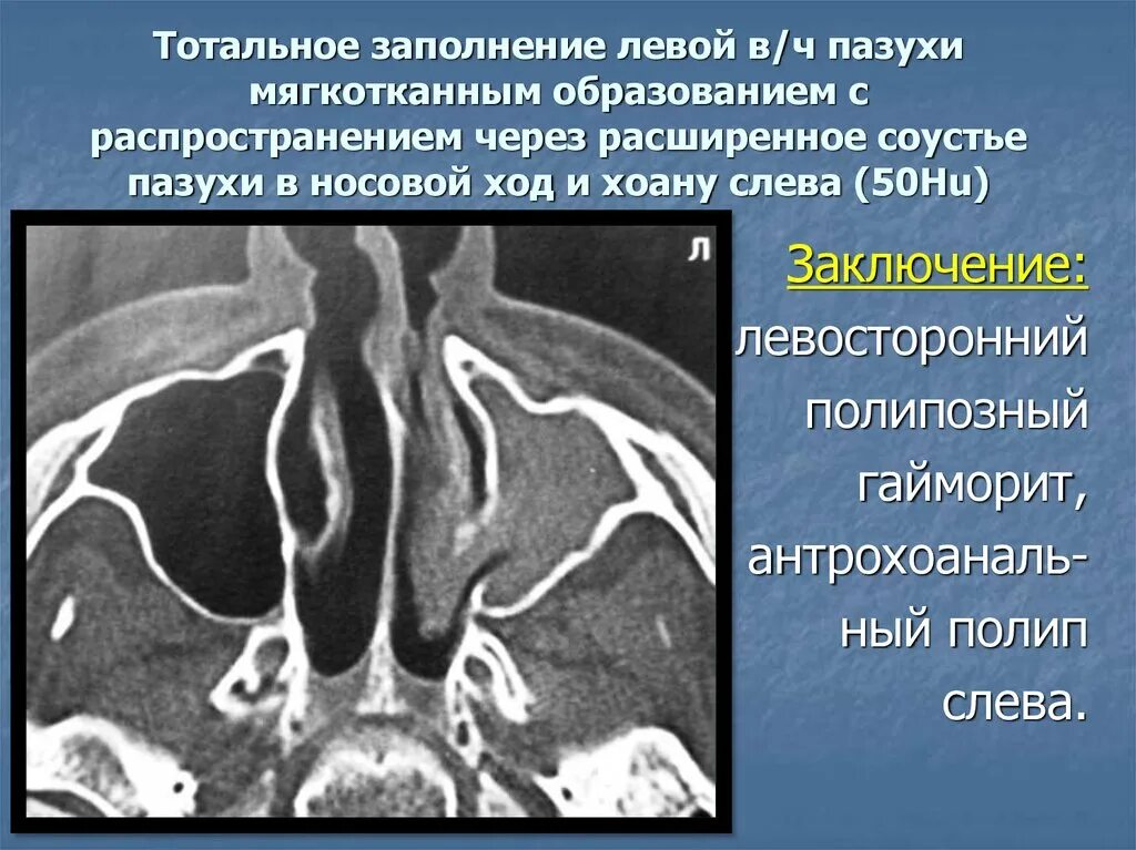 Пристеночное утолщение слизистой оболочки. Полипозный риносинусит кт. СКТ пазух пазухи носа. Хронический синусит кт.