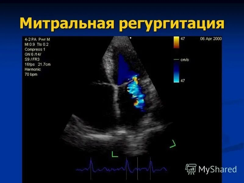 Митральный клапан ЭХОКГ. Митральная недостаточность допплер эхокардиография. Эхокардиография митральная регургитация. Аортальная регургитация на ЭХОКГ.