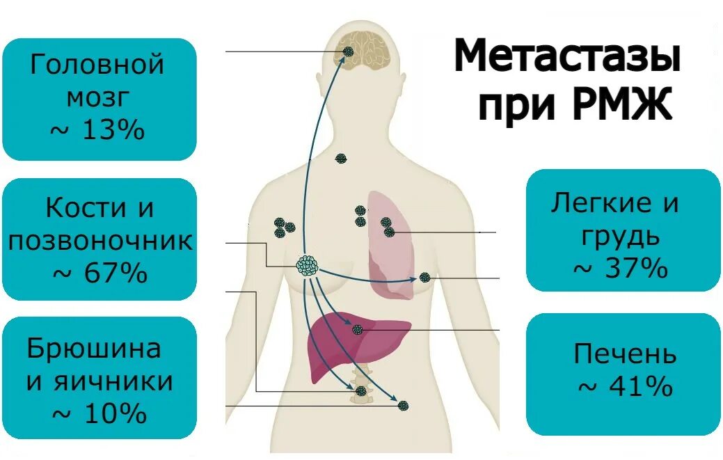 Метастазы иолочнойжелезы. Метастазы опухоли молочной железы. Пути метастазирования РМЖ.