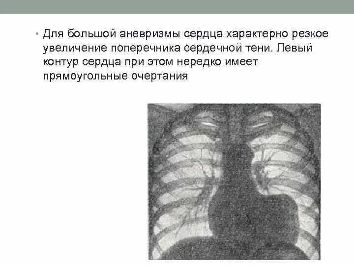 Что значит расширен поперечник сердца. Что значит расширен поперечник сердца