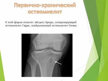 Хронический остеомиелит
