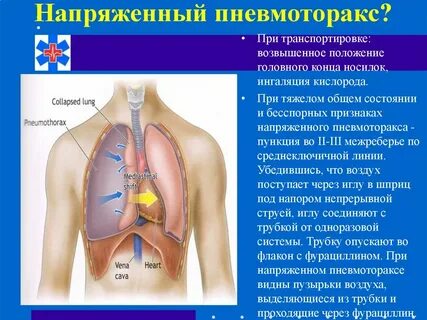 Уход при пневмотораксе
